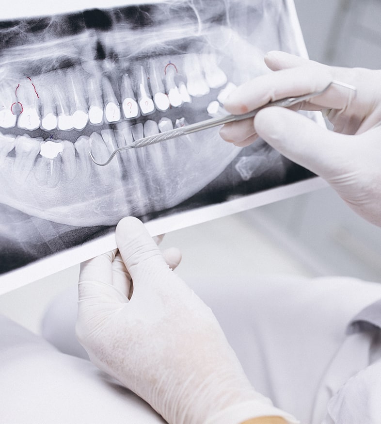 colocación implantes dentales bilbao