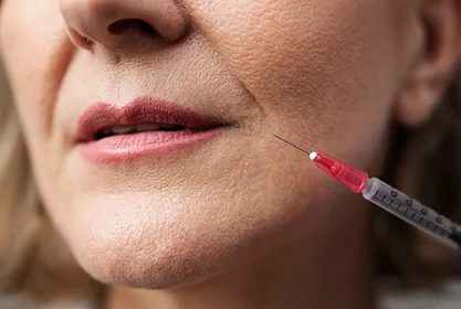 arrugas_periorales_acido_MD (1)