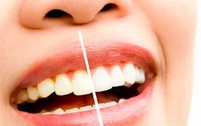 ¿Cuáles son todos los tipos de blanqueamiento dental que existen y cuál es el más efectivo?
