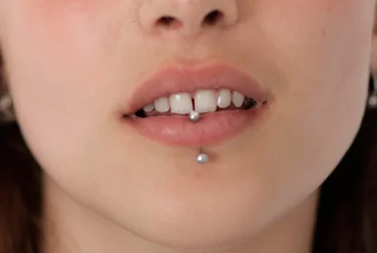 cicatrices_piercing_acido_hialuronico_MD (1)