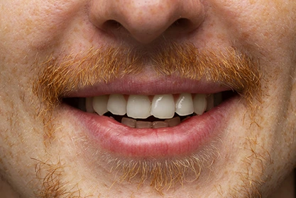 dientes-apiñados-torcidos