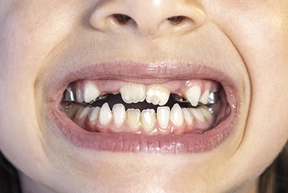 ortodoncia-maloclusiones