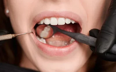 ¿Por qué me sangran las encías? Todo lo que debes saber sobre la Gingivitis