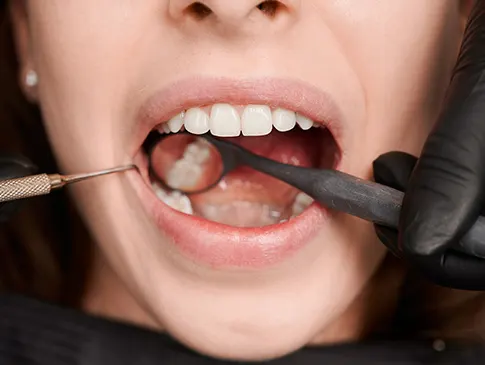 ¿Por qué me sangran las encías? Todo lo que debes saber sobre la Gingivitis