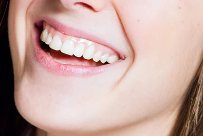 sonrisa_gingival_MD (1)