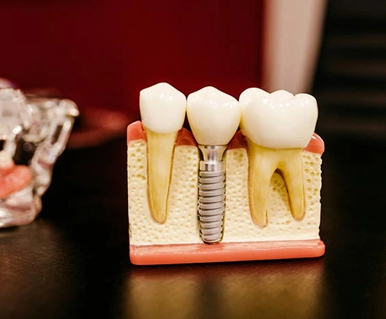 implantologia_dental_bilbao