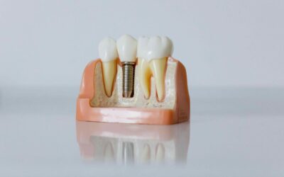 ¿Cuáles son los tres tipos de implantes dentales?